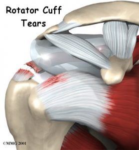 shoulder-rotator-cuff-tear