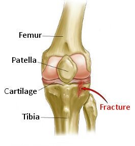 tibial plateau fracture