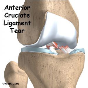 anterior-cruciate-ligament-tear